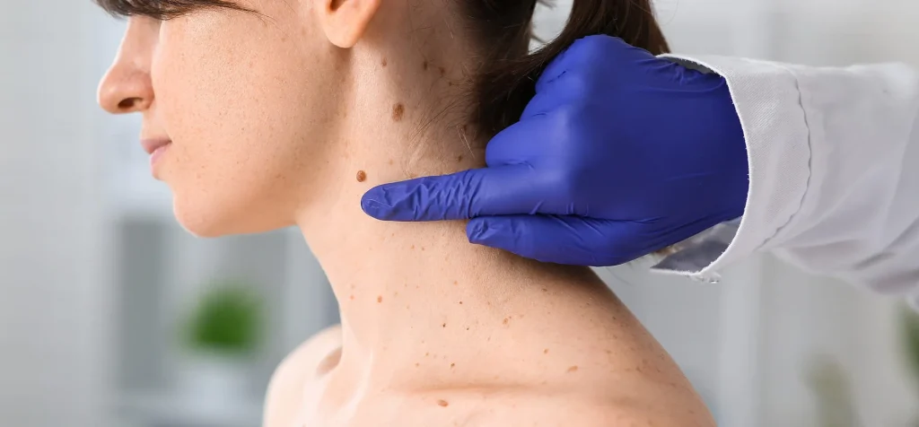 Chequeo de Lunares: 3 claves para atacar al cáncer de piel